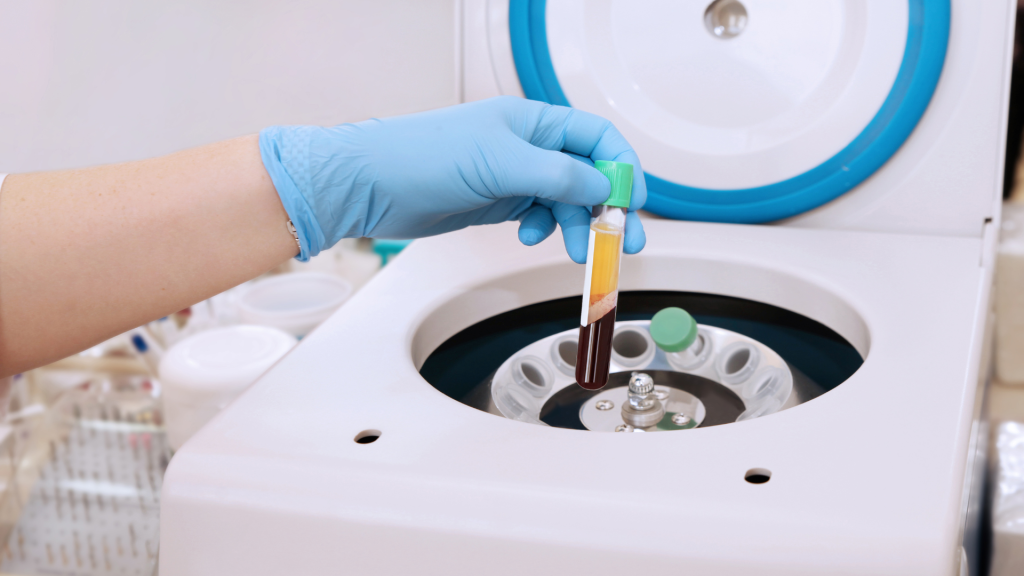 PRP: Il Potere Rigenerativo del tuo Sangue sta riscrivendo il futuro della cura